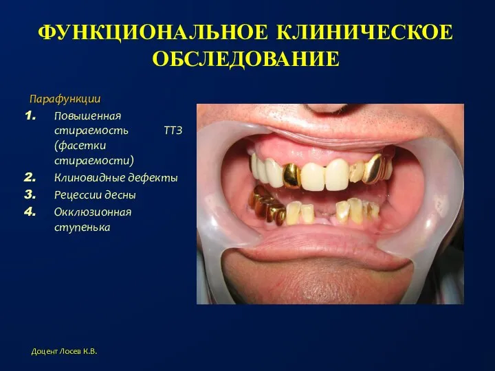 ФУНКЦИОНАЛЬНОЕ КЛИНИЧЕСКОЕ ОБСЛЕДОВАНИЕ Парафункции Повышенная стираемость ТТЗ (фасетки стираемости) Клиновидные дефекты Рецессии