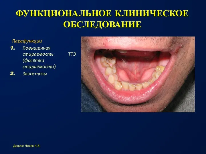 ФУНКЦИОНАЛЬНОЕ КЛИНИЧЕСКОЕ ОБСЛЕДОВАНИЕ Парафункции Повышенная стираемость ТТЗ (фасетки стираемости) Экзостозы Доцент Лосев К.В.