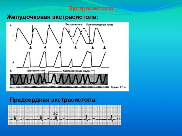 Экстрасистола Желудочковая экстрасистола: Предсердная экстрасистола: