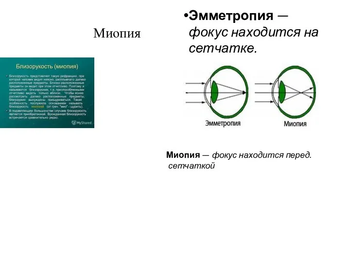 Миопия Эмметропия — фокус находится на сетчатке. Миопия — фокус находится перед. сетчаткой