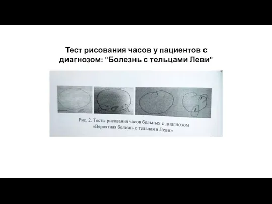 Тест рисования часов у пациентов с диагнозом: "Болезнь с тельцами Леви"