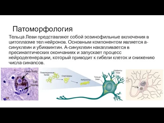 Патоморфология Тельца Леви представляют собой эозинофильные включения в цитоплазме тел нейронов. Основным
