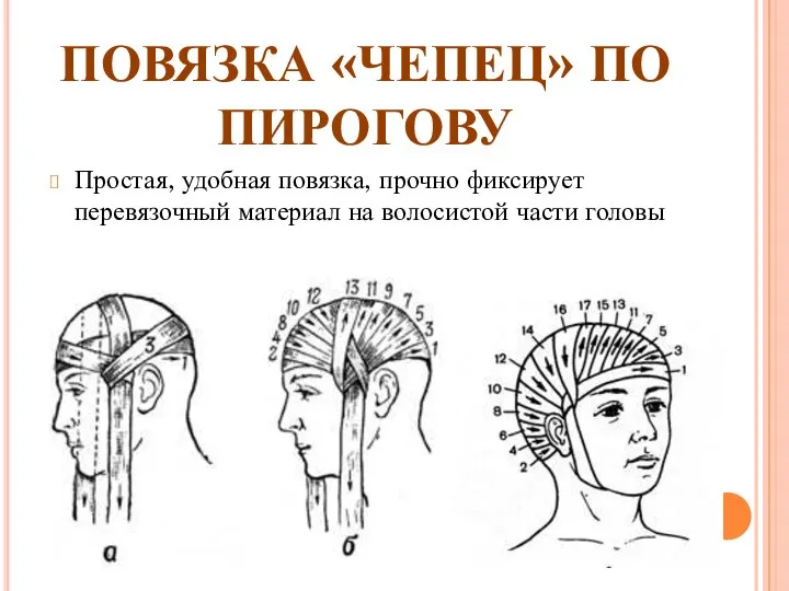 ПОВЯЗКА «ЧЕПЕЦ» ПО ПИРОГОВУ Простая, удобная повязка, прочно фиксирует перевязочный материал на волосистой части головы