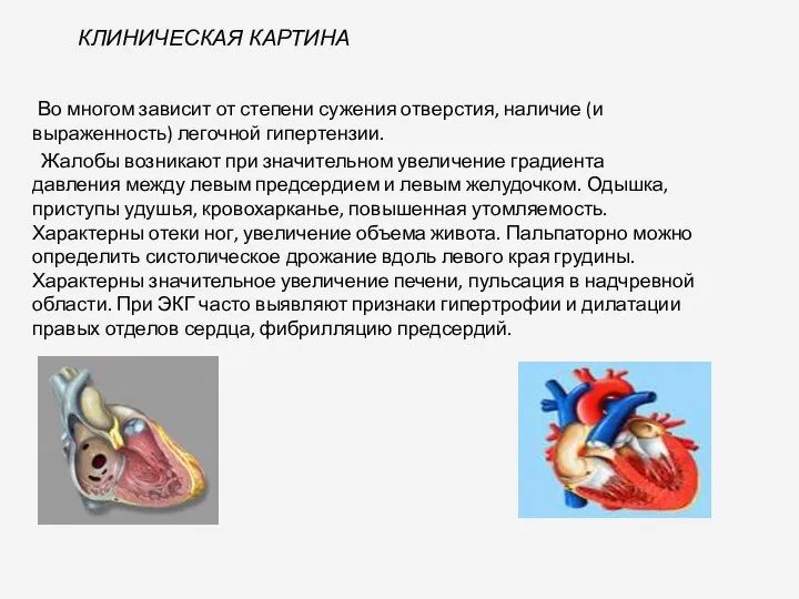 КЛИНИЧЕСКАЯ КАРТИНА Во многом зависит от степени сужения отверстия, наличие (и выраженность)