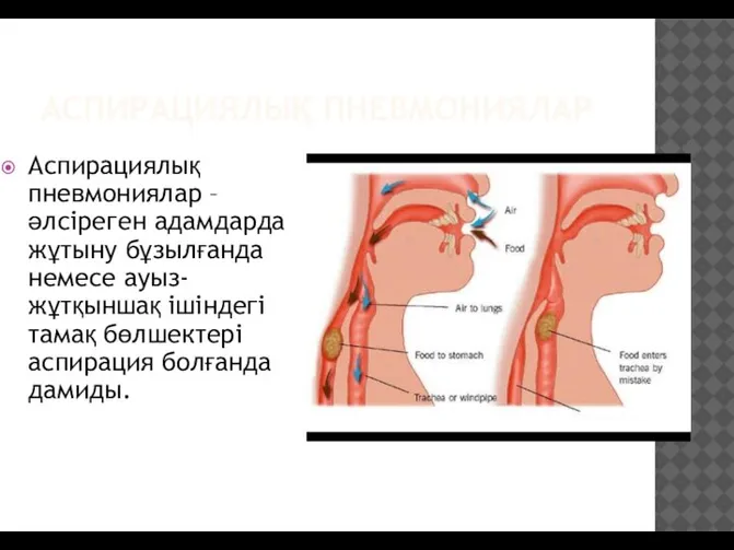 АСПИРАЦИЯЛЫҚ ПНЕВМОНИЯЛАР Аспирациялық пневмониялар – әлсіреген адамдарда жұтыну бұзылғанда немесе ауыз-жұтқыншақ ішіндегі