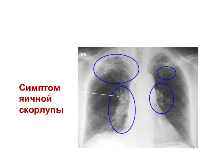 Симптом яичной скорлупы