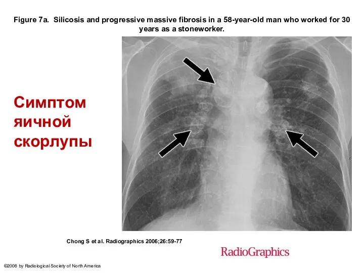 Figure 7a. Silicosis and progressive massive fibrosis in a 58-year-old man who