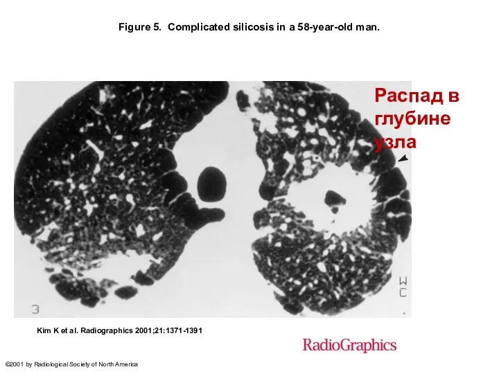 Figure 5. Complicated silicosis in a 58-year-old man. Kim K et al.