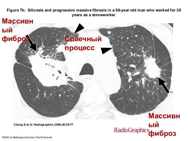 Figure 7b. Silicosis and progressive massive fibrosis in a 58-year-old man who