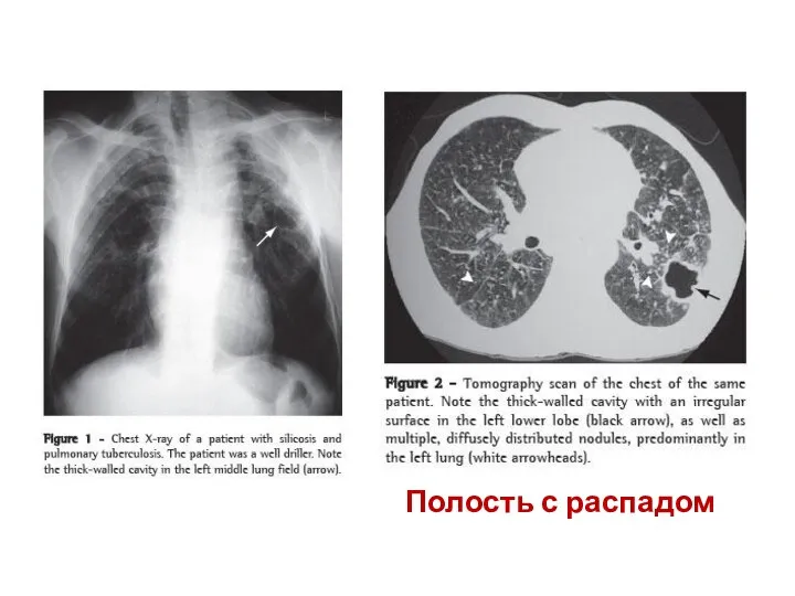 Полость с распадом