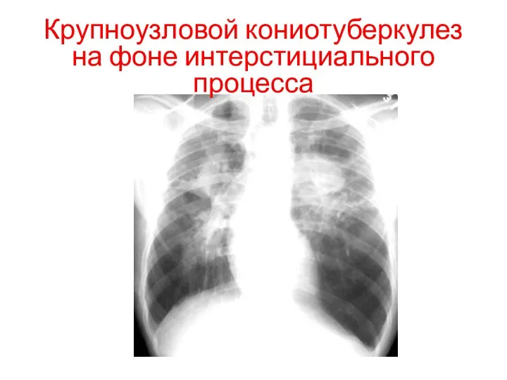 Крупноузловой кониотуберкулез на фоне интерстициального процесса