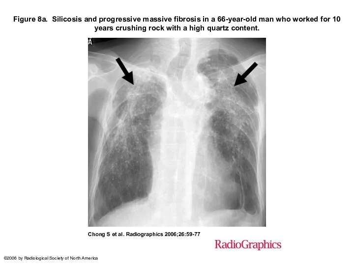Figure 8a. Silicosis and progressive massive fibrosis in a 66-year-old man who
