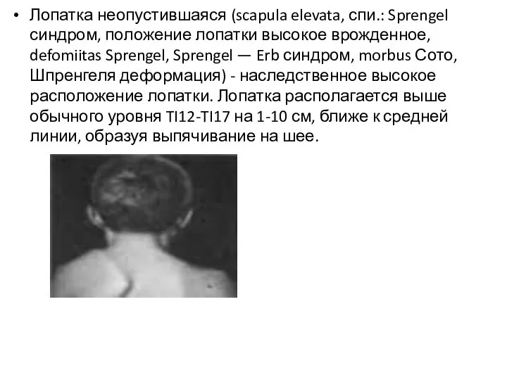 Лопатка неопустившаяся (scapula elevata, спи.: Sprengel синдром, положение лопатки высокое врожденное, defomiitas