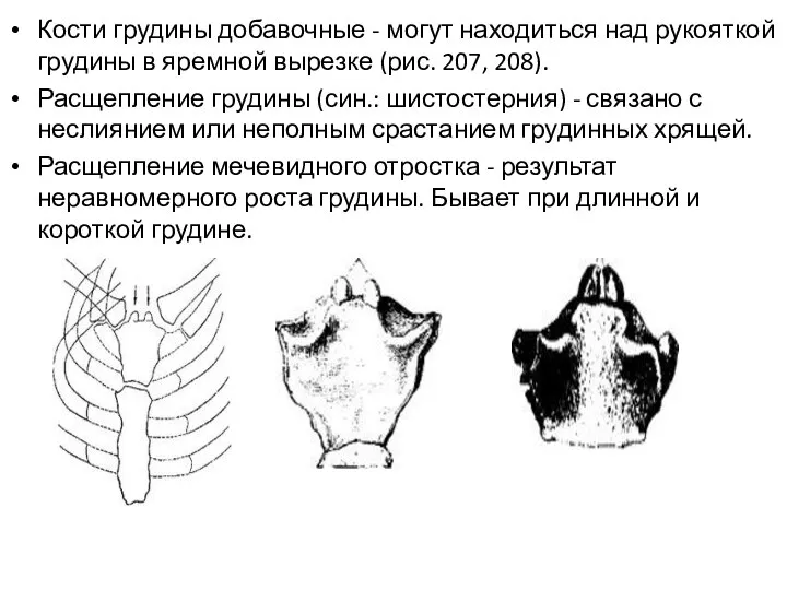 Кости грудины добавочные - могут находиться над рукояткой грудины в яремной вырезке