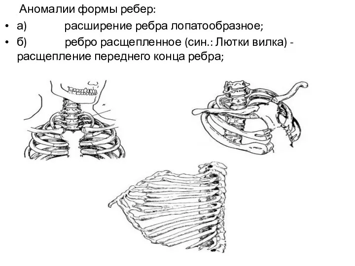 Аномалии формы ребер: а) расширение ребра лопатообразное; б) ребро расщепленное (син.: Лютки