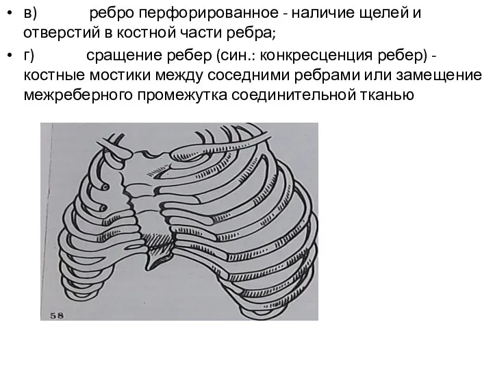 в) ребро перфорированное - наличие щелей и отверстий в костной части ребра;