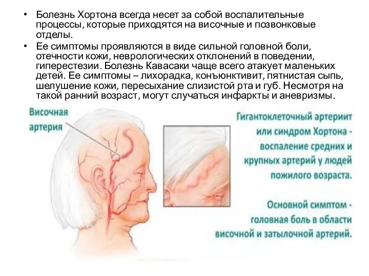 Болезнь Хортона всегда несет за собой воспалительные процессы, которые приходятся на височные