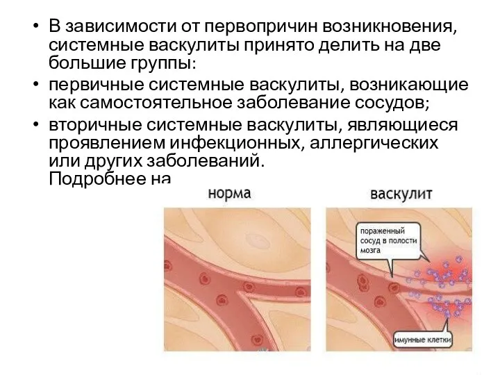 В зависимости от первопричин возникновения, системные васкулиты принято делить на две большие