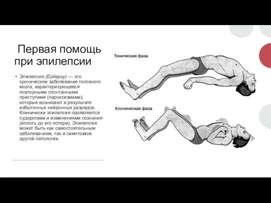 Первая помощь при эпилепсии Эпилепсия (Epilepsy) — это хроническое заболевание головного мозга,