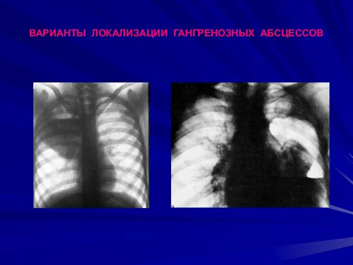 ВАРИАНТЫ ЛОКАЛИЗАЦИИ ГАНГРЕНОЗНЫХ АБСЦЕССОВ