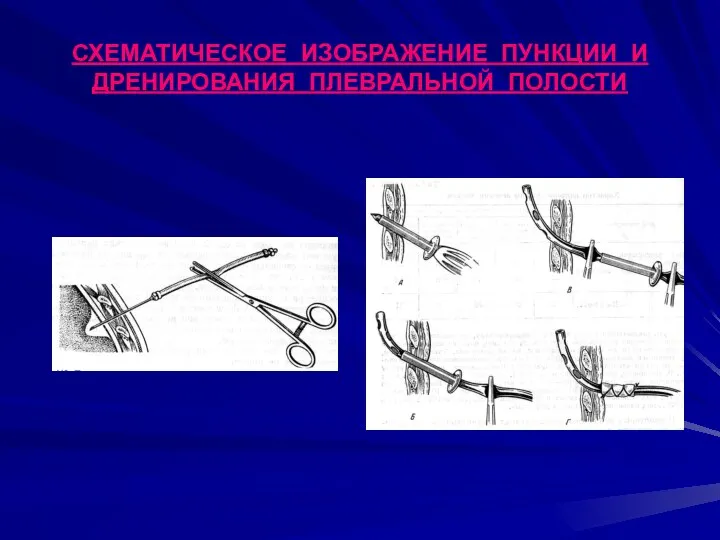 СХЕМАТИЧЕСКОЕ ИЗОБРАЖЕНИЕ ПУНКЦИИ И ДРЕНИРОВАНИЯ ПЛЕВРАЛЬНОЙ ПОЛОСТИ