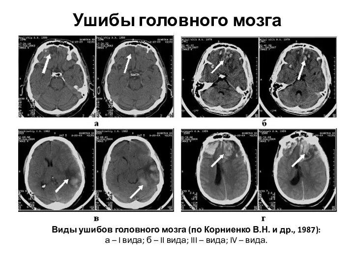 Ушибы головного мозга Виды ушибов головного мозга (по Корниенко В.Н. и др.,