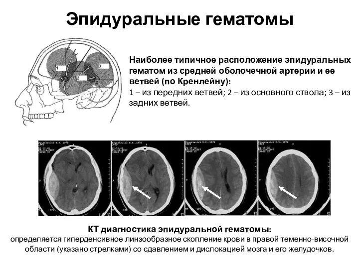 Эпидуральные гематомы Наиболее типичное расположение эпидуральных гематом из средней оболочечной артерии и