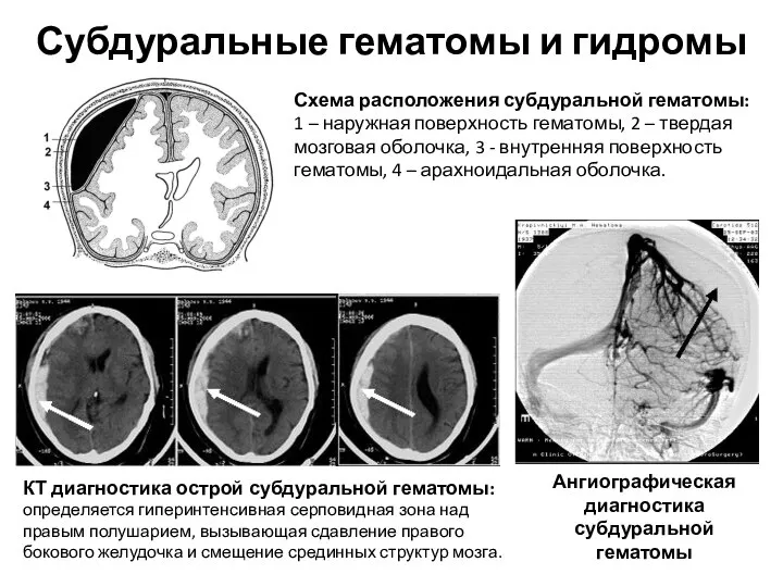 Схема расположения субдуральной гематомы: 1 – наружная поверхность гематомы, 2 – твердая