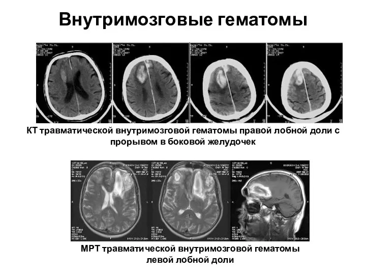 Внутримозговые гематомы КТ травматической внутримозговой гематомы правой лобной доли с прорывом в