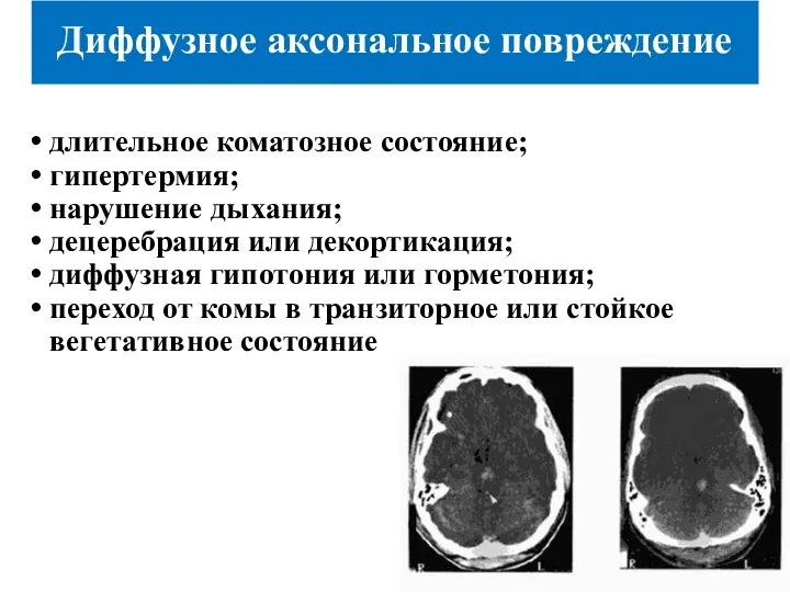 Диффузное аксональное повреждение длительное коматозное состояние; гипертермия; нарушение дыхания; децеребрация или декортикация;