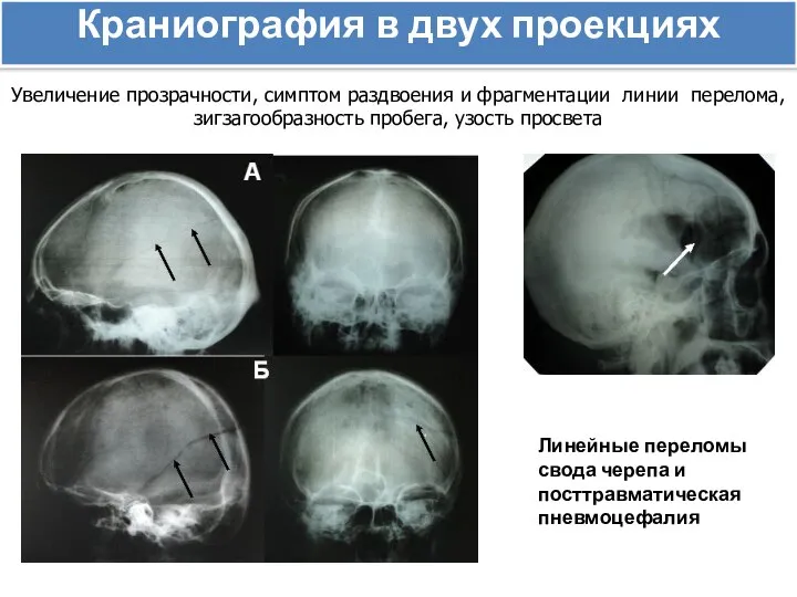 Краниография в двух проекциях Увеличение прозрачности, симптом раздвоения и фрагментации линии перелома,