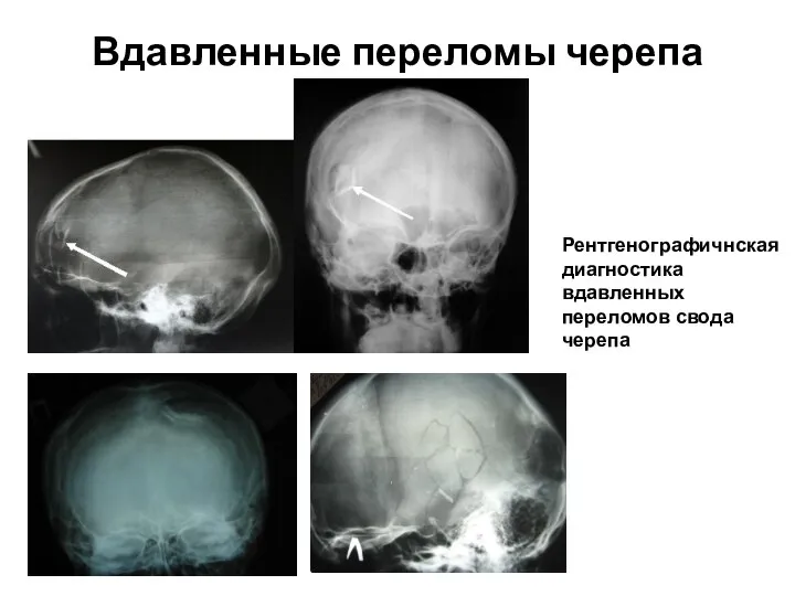 Вдавленные переломы черепа Рентгенографичнская диагностика вдавленных переломов свода черепа