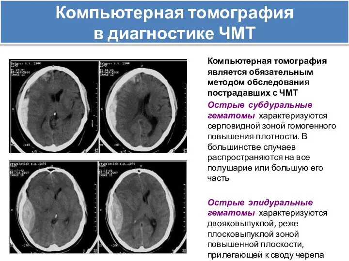 Компьютерная томография в диагностике ЧМТ Компьютерная томография является обязательным методом обследования пострадавших