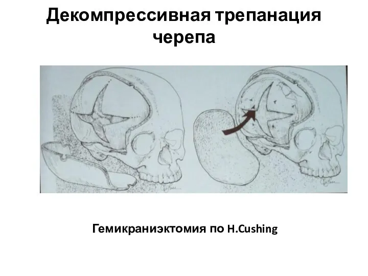 Декомпрессивная трепанация черепа Гемикраниэктомия по H.Cushing