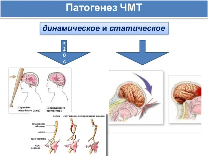 динамическое и статическое Патогенез ЧМТ