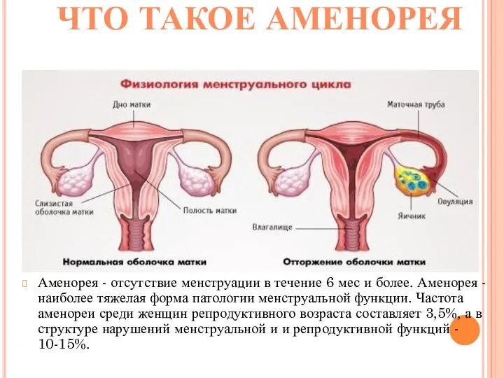 ЧТО ТАКОЕ АМЕНОРЕЯ Аменорея - отсутствие менструации в течение 6 мес и