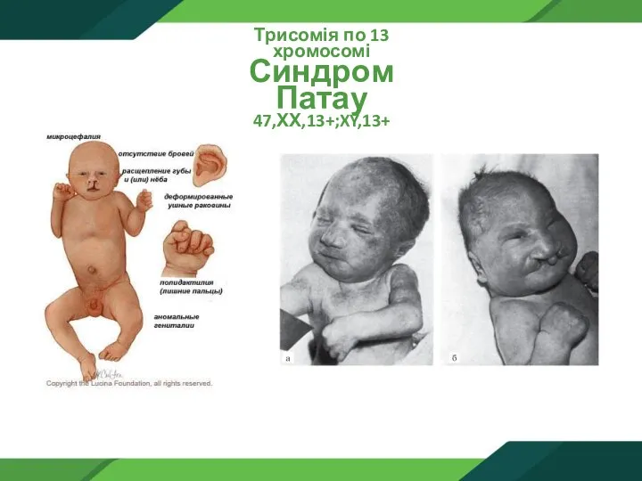 Трисомія по 13 хромосомі Синдром Патау 47,ХХ,13+;XY,13+