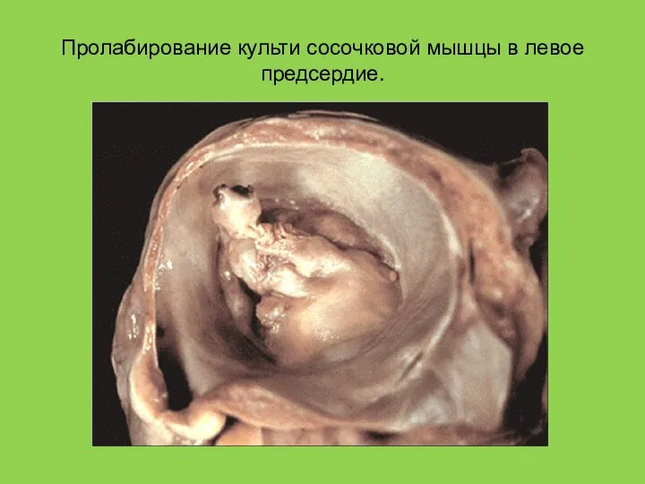 Пролабирование культи сосочковой мышцы в левое предсердие.