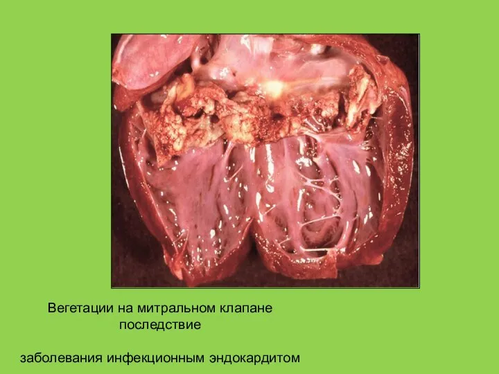Вегетации на митральном клапане последствие заболевания инфекционным эндокардитом