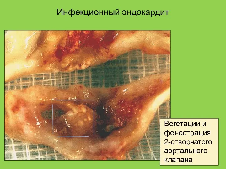 Инфекционный эндокардит Вегетации и фенестрация 2-створчатого аортального клапана