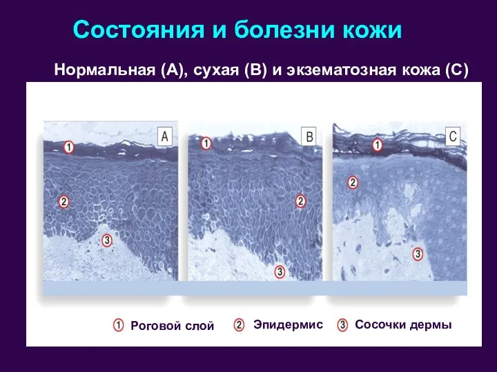 Нормальная (А), сухая (В) и экзематозная кожа (С) Состояния и болезни кожи