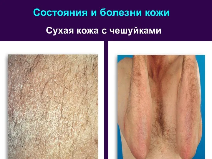 Состояния и болезни кожи Сухая кожа с чешуйками