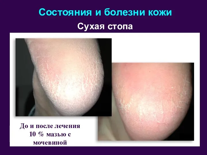 Состояния и болезни кожи Сухая стопа До и после лечения 10 % мазью с мочевиной