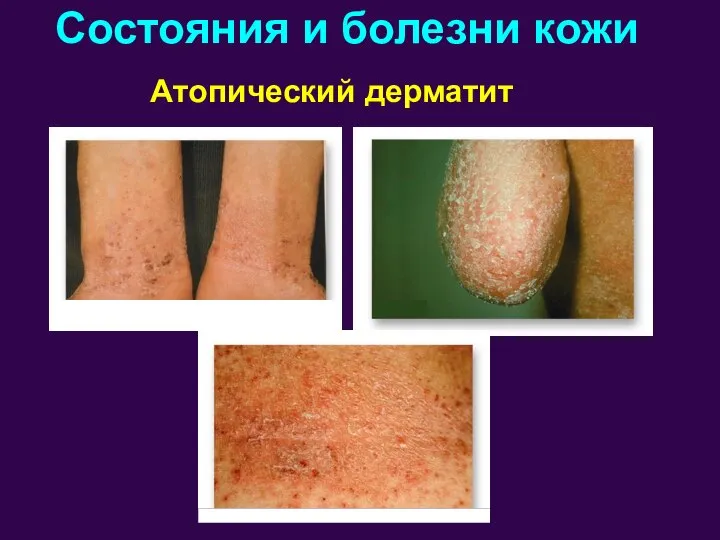 Атопический дерматит Состояния и болезни кожи