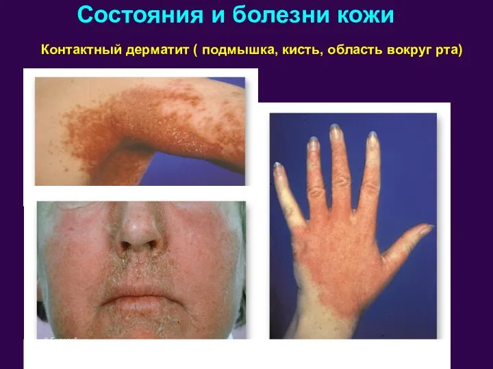 Состояния и болезни кожи Контактный дерматит ( подмышка, кисть, область вокруг рта)