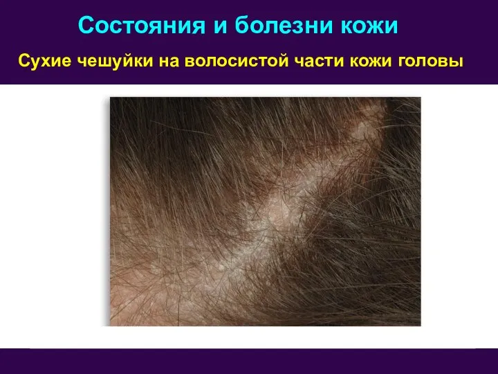 Состояния и болезни кожи Сухие чешуйки на волосистой части кожи головы