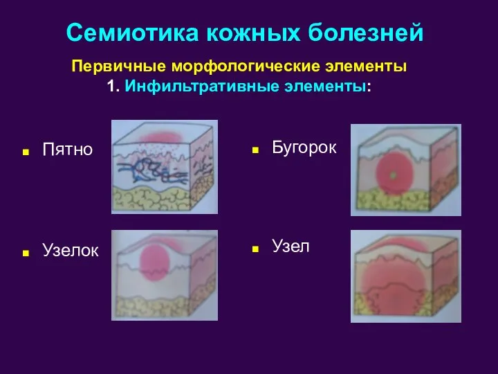 Пятно Узелок Семиотика кожных болезней Первичные морфологические элементы 1. Инфильтративные элементы: Бугорок Узел