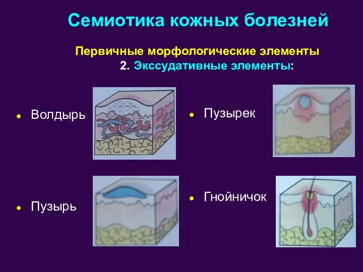 Волдырь Пузырь Пузырек Гнойничок Семиотика кожных болезней Первичные морфологические элементы 2. Экссудативные элементы: