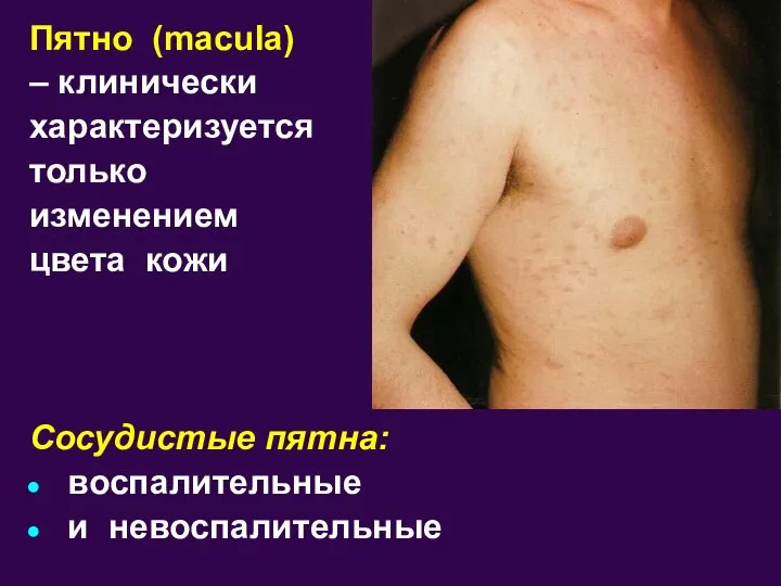Пятно (macula) – клинически характеризуется только изменением цвета кожи Сосудистые пятна: воспалительные и невоспалительные