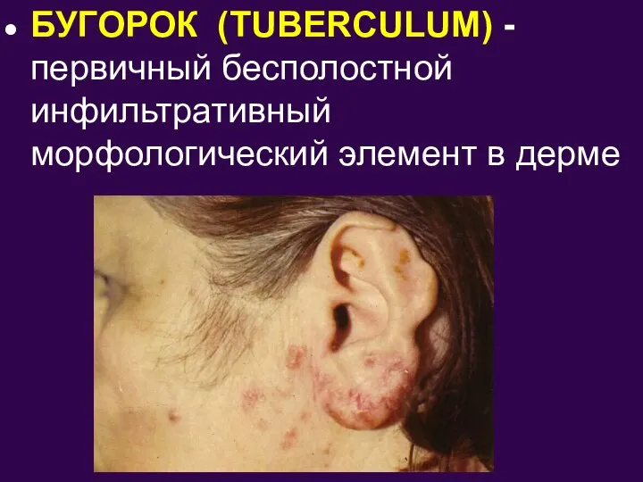 БУГОРОК (TUBERCULUM) - первичный бесполостной инфильтративный морфологический элемент в дерме